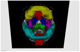 Images des ROIs : cortex frontal et préfrontal (jaune), cingulaire antérieur (rouge en avant de la coupe), insulaire (violet), somesthésiques SI et SII (bleu clair), noyaux caudé et lenticulaires (bleu roi), thalamus (vert), et precuneus (rouge en arrière de la coupe)
