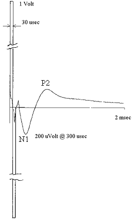 Figure 41. Potentiel d’action composite électrique (ECAP)