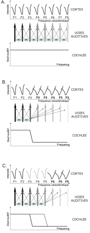 Figure 77. Représentation schématique des fréquences caractéristiques des neurones du cortex auditif chez un sujet sain (A), un sujet malentendant présentant une perte abrupte aux hautes fréquences (B) et un sujet malentendant appareillé (C). Cette figure illustre les mécanismes de levée d’inhibition latérale présents chez le sujet malentendant qui permettent une sur-représentation de la dernière fréquence saine. La perte de sélectivité fréquentielle des neurones de la zone sur-représentée est également illustrée (Rajan et coll., 1993). Chez le sujet malentendant appareillé l’inhibition latérale pourrait à nouveau se mettre en place jusqu’à la limite d’amplification de l’appareillage.