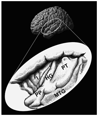Figure 1.1.3. Dessin du cortex auditif, à l’intérieur de la scissure de Sylvius, sur le gyrus temporal supérieur. Le cortex auditif comprend le gyrus de Heschl (HG), le planum polare (PP) et le planum temporale (PT). Le cortex auditif est bordé par l’insula (I) et le gyrus temporal médian (MTG). Johnsrude, Giraud, et Frackowiak, 2002, Fig.3.