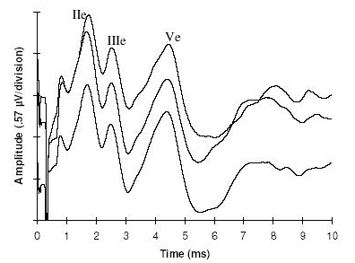 Figure 2. EABR measures recorded from Subject 2 on electrode 4 (apical electrode) at comfortably loud intensity. A stimulus artefact is present within the first 0.8 ms after stimulus onset.  