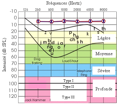 Figure 28. Classification des surdités selon le BIAP.