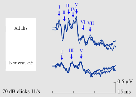 Figure 22. Potentiels évoqués précoces chez l’adulte et chez l’enfant. Deux enregistrements sont superposés à chaque fois pour montrer la reproductibilité des ondes. L’adulte présente des latences plus courtes et des amplitudes plus amples que l’enfant, chez qui certaines ondes (II, IV, VI, VII) ne sont pas encore apparues.