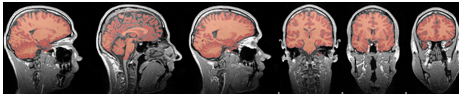 Image de segmentation du cerveau, distinguant la SG (couleur foncée), de la SB (couleur claire)