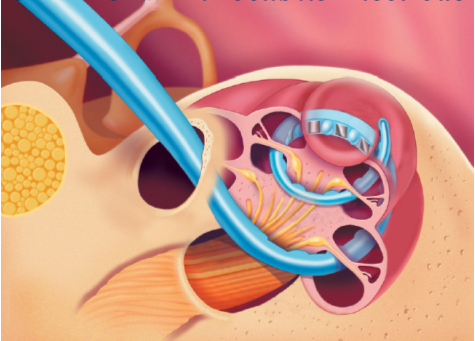 Figure 34. Schéma illustrant l’insertion du faisceau d’électrodes dans le canal tympanique de la cochlée.