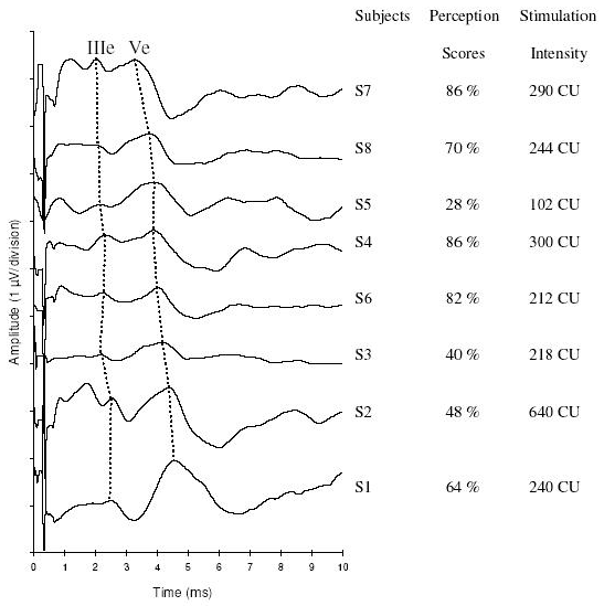 Figure 3. Averaged EABR waveforms recorded at comfortably loud intensities on electrode 7 (medium electrode) from all eight subjects. Waves IIIe and Ve are indicated. The subjects scores to speech perception test in quiet (voice at 65 dB HL) at three months of cochlear implant use are indicated.  