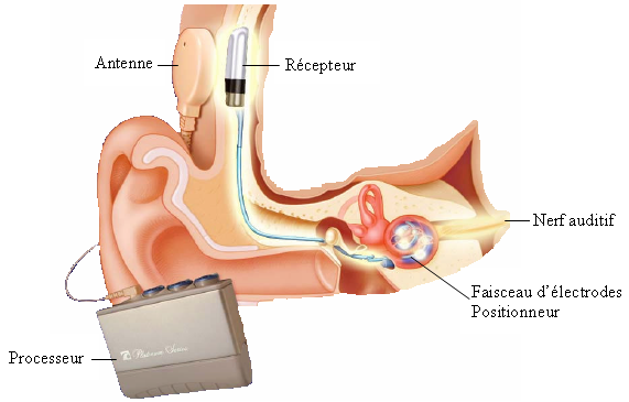 Figure 31. Illustration schématique des différents composants internes et externes de l’implant cochléaire.