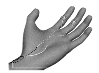 Figure 40 : Illustration de la pose des électrodes sur la main