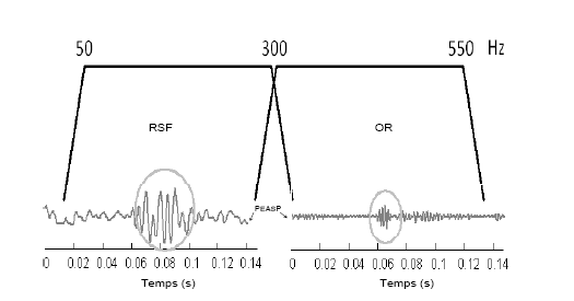 Figure 33 : Représentation temporelle de deux traces PEASP avec les caractéristiques temporelles de l’onset response (OR) et de la réponse soutenue à la fréquence (RSF).