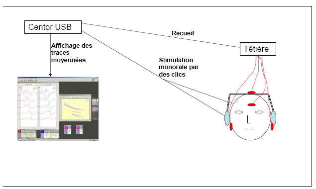 Figure 11 : Représentation schématique du système de recueil des PEAP, ici avec le système Centor USB Racia Alvar®.