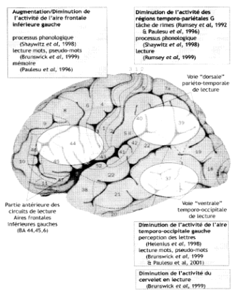Figure 1.15 : Aires cérébrales déficitaires chez les sujets dyslexiques par rapport aux sujets normo-lecteurs, en modalité visuelle (adapté de (Demonet et al., 2004))
